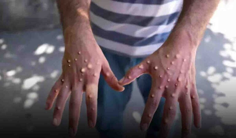 Mpox Outbreak: Government Issues Alert to International Airports as WHO Declares Global Public Health Emergency, 99,176 Reported Cases Since 2022
